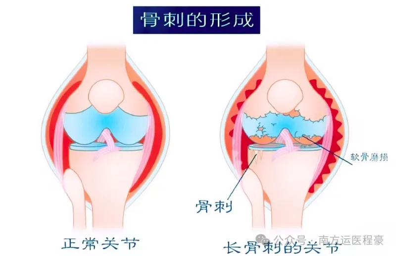 膝关节骨刺：究竟是“保护神”还是“捣蛋鬼”？(图1)