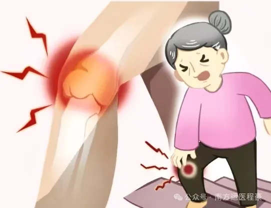 膝关节骨刺：究竟是“保护神”还是“捣蛋鬼”？(图2)